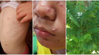 “วิธีเเก้โรคอีสุกอีใส” สูตรน้ำต้มอาบ ช่วยให้อีสุกอีใสหายไวขึ้น!