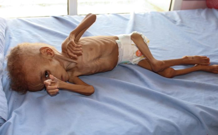เผยภาพสลด! สงครามเยเมนทำเด็ก 5 ล้านคนต้องอดอาหาร 