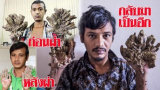 หนุ่มมนุษย์ต้นไม้ อยากให้หมอตัดมือทิ้ง เผยทุกข์ทรมานพอแล้ว