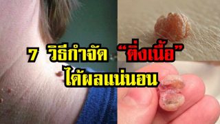 7 วิธีกำจัด “ติ่งเนื้อ” ด้วยวิธีธรรมชาติ หาได้ง่ายๆในครัว