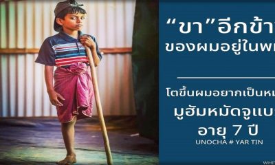 มูฮัมหมัดจูแบร์ อายุ 7 ปี ถูกทหารพม่าทำร้าย เสียขาหนึ่งข้าง